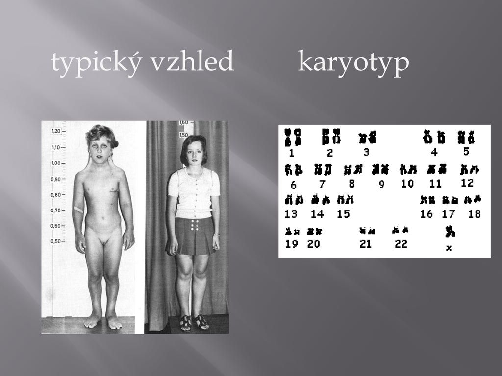 typický vzhled karyotyp