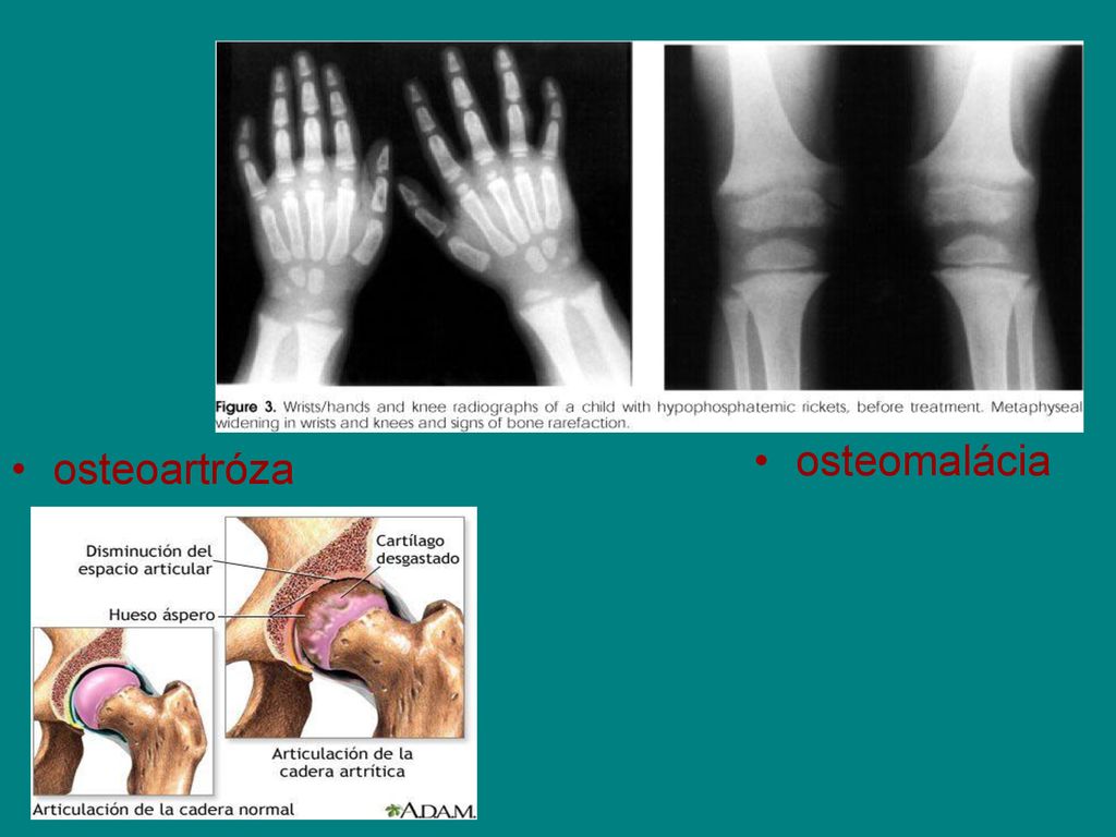 osteomalácia osteoartróza