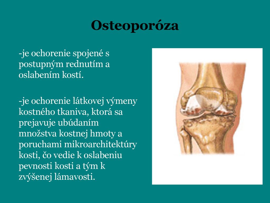 Osteoporóza je ochorenie spojené s postupným rednutím a oslabením kostí.